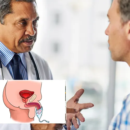 Why Choose   Urological Consultants of Florida 
for Penile Implant Care